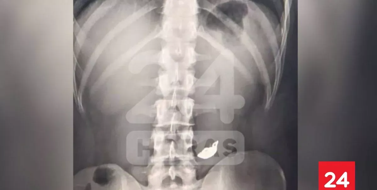 Joven delincuente se tragó una cadena que robó para despistar a carabineros en Valparaíso