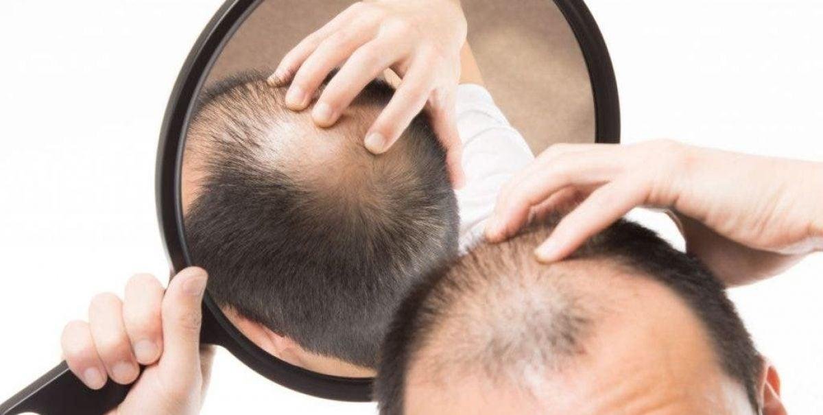 ISP advierte por medicamento para la calvicie que puede producir ideación suicida y disfunción erectil