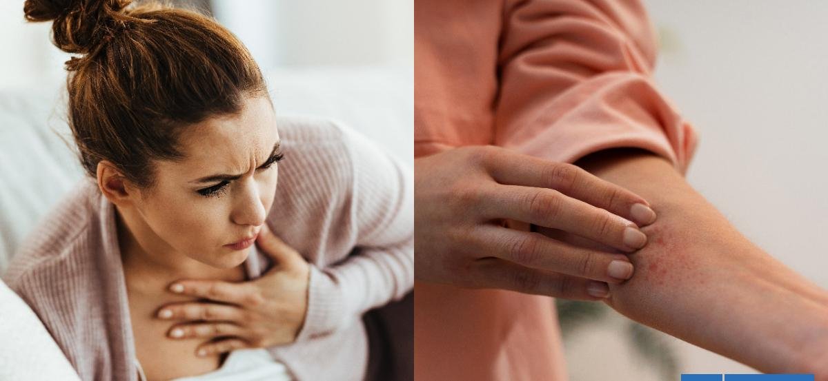 Reacción alérgica severa: cómo identificar sus síntomas a tiempo y qué hacer en una emergencia