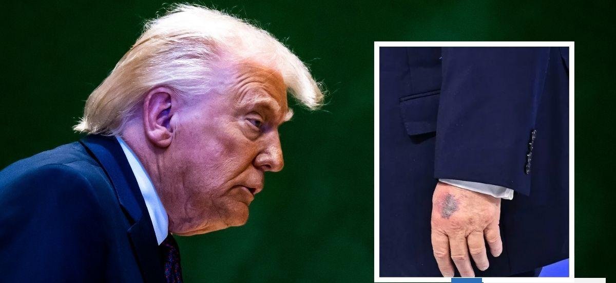 Aspirinas, maquillaje y versiones cruzadas: el misterio tras los nuevos moretones de Donald Trump