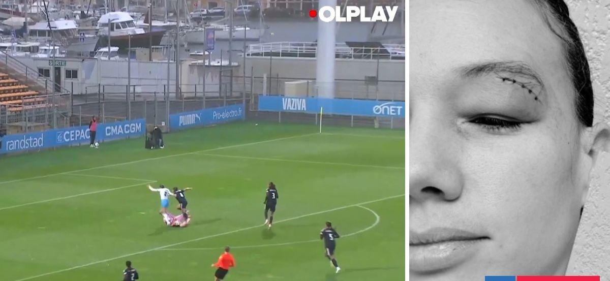 Christiane Endler sufrió golpe en la cabeza y salió lesionada en Copa de Francia femenina