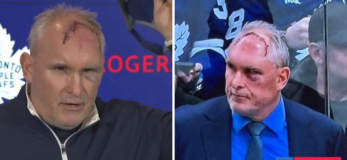 Entrenador de NHL impactó al mostrar cicatriz con 50 puntos de sutura: su explicación causó risas