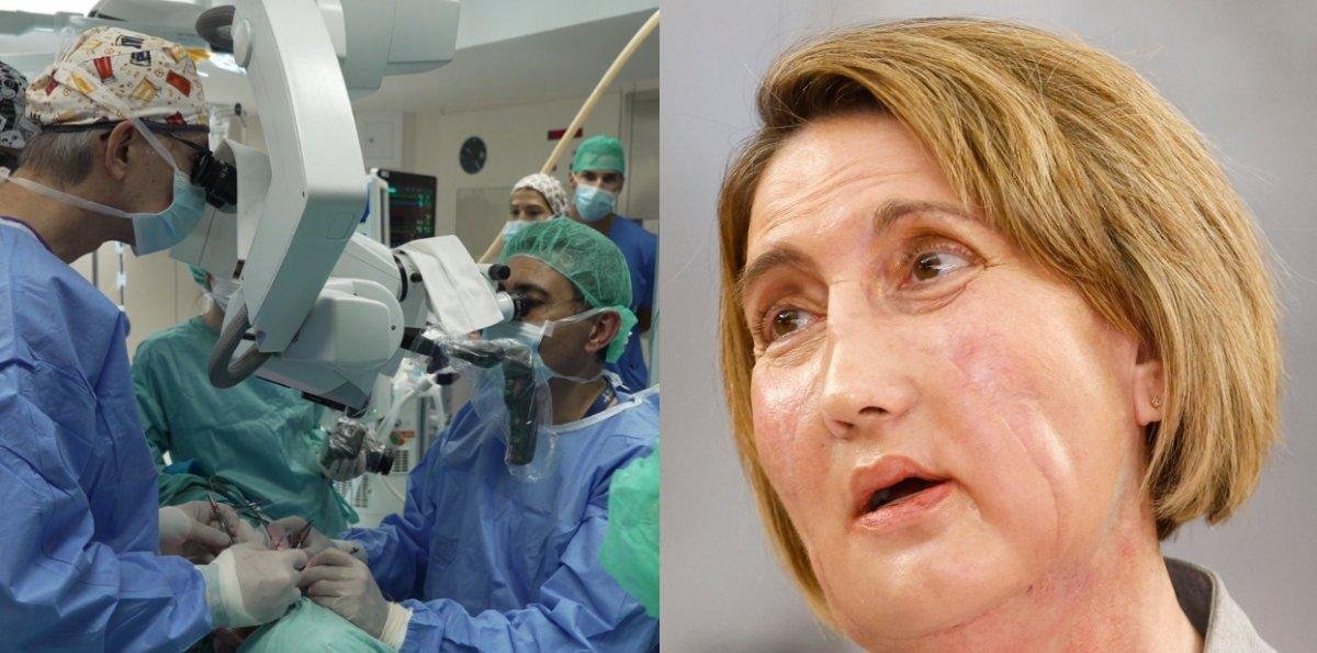 Barcelona: Inédito trasplante de cara con una donante que recibió la eutanasia