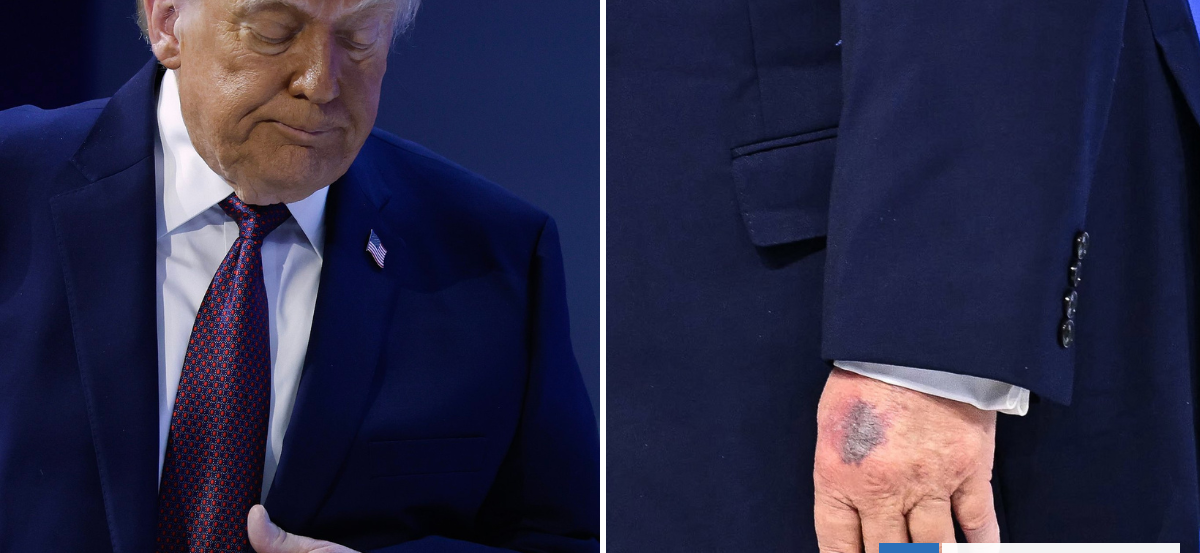 Donald Trump vuelve a generar preocupación por su salud al evidenciar morentones en sus manos