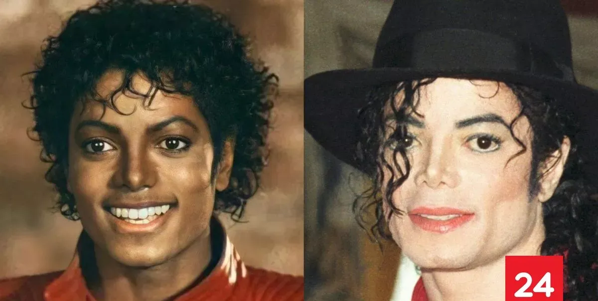 El vitíligo, la incomprendida enfermedad que cambió para siempre a Michael Jackson