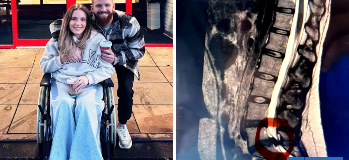 Mujer cayó de espalda y fue diagnosticada con síndrome de la cola de caballo: estos son los síntomas