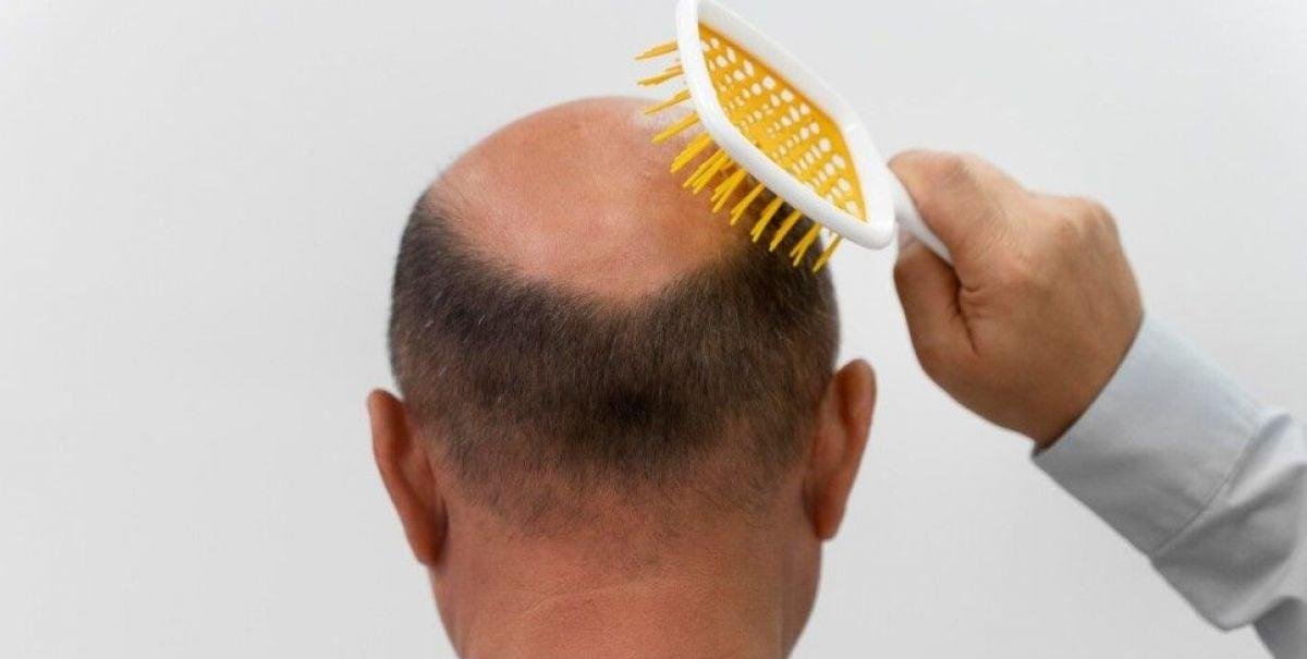 Fármaco contra la calvicie puede generar "riesgo de ideación suicida" según estudio