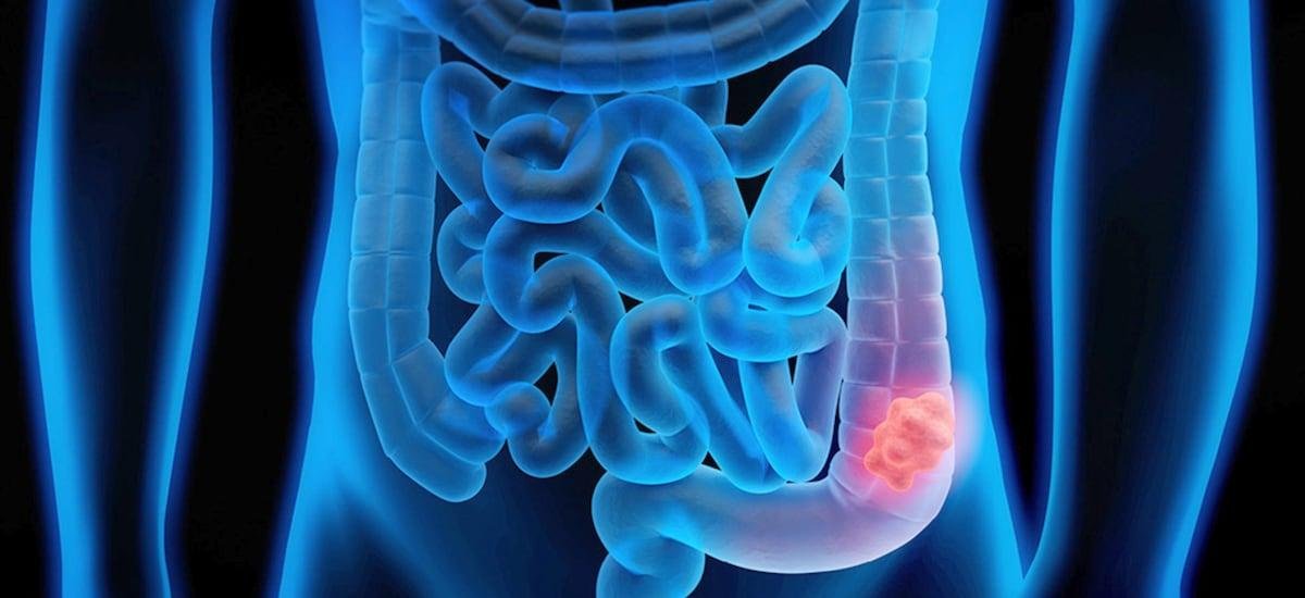 Qué es el cáncer colorrectal, cada vez más común entre adultos jóvenes (y cuáles son sus síntomas)