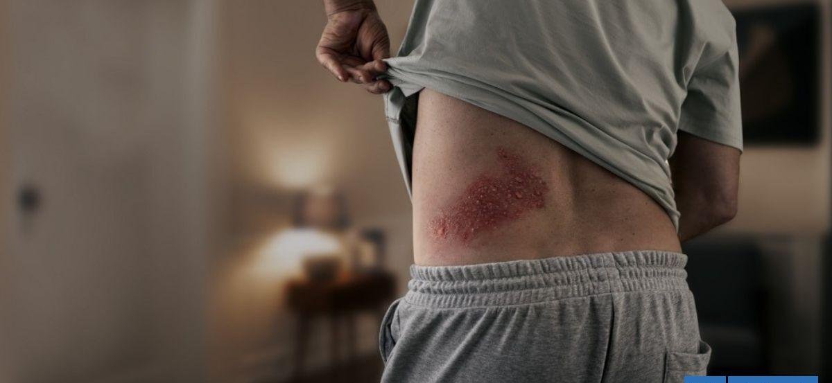 Los silenciosos peligros del herpes zóster: 95% de los adultos están en riesgo de tenerlos