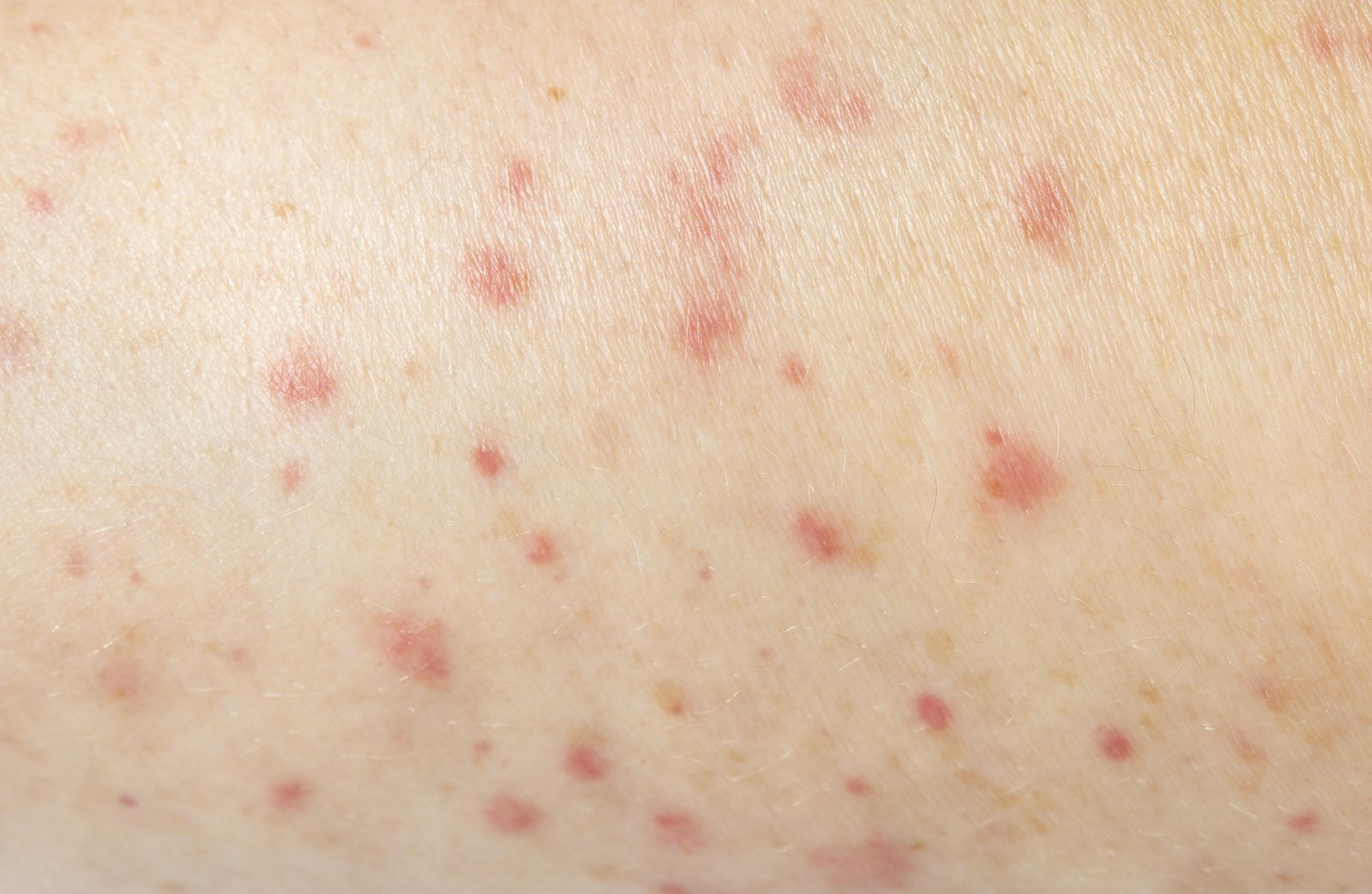 Cómo identificar los síntomas del sarampión y qué hacer si los presentas