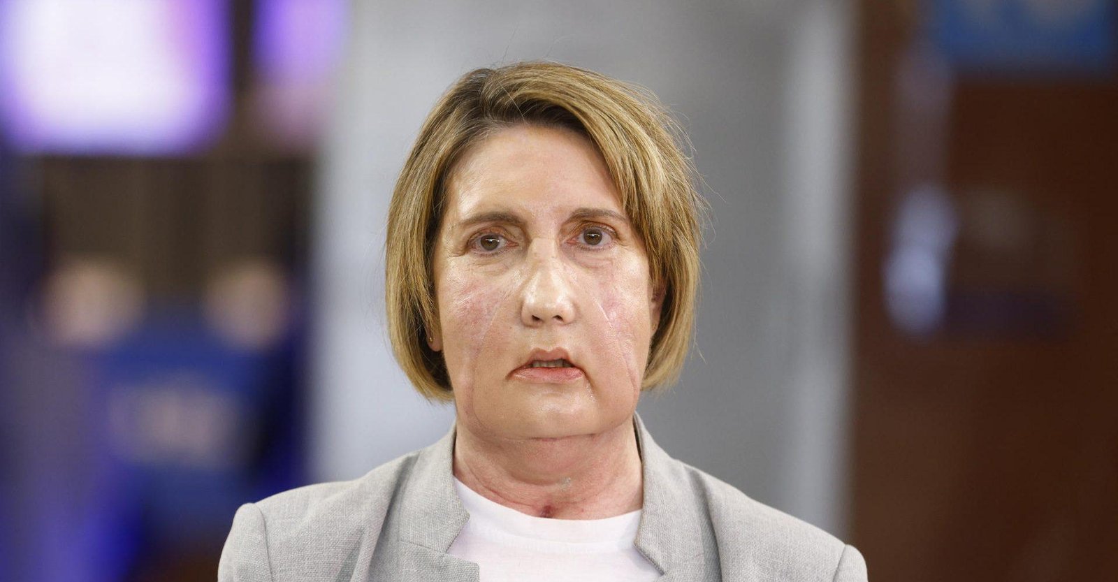 Realizan el primer trasplante de cara del mundo con una donante que recibió eutanasia