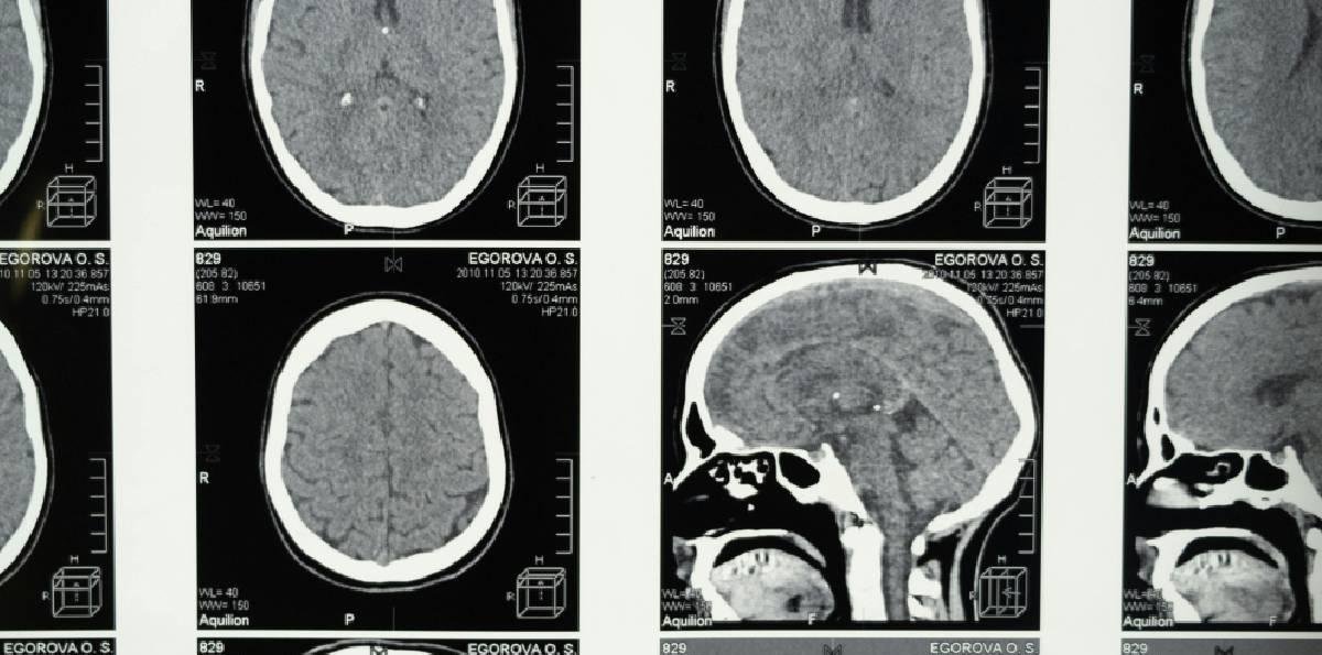 Una investigación británica vincula la menopausia con síntomas similares al Alzheimer