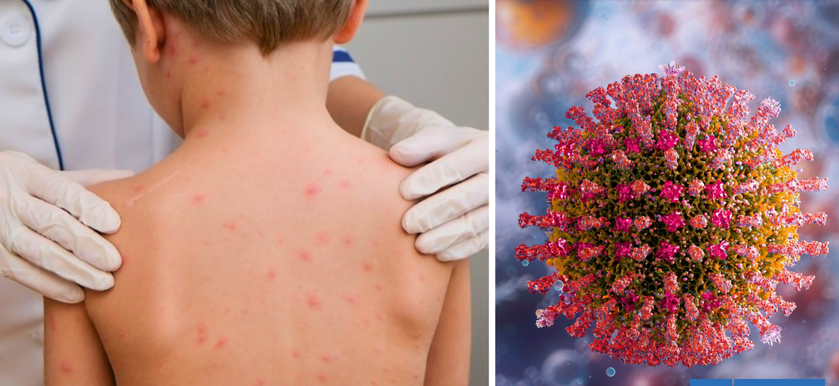 Minsal confirma caso importado de sarampión en un lactante: estuvo recientemente en México