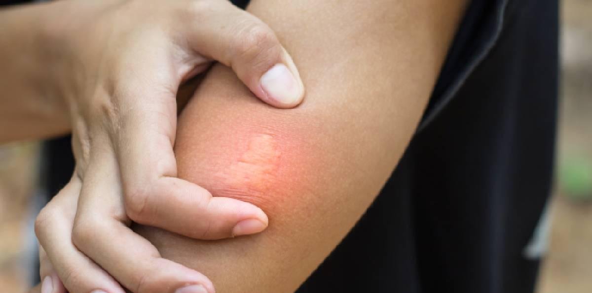 Cómo cuidar y prevenir las picaduras de zancudos y otros insectos