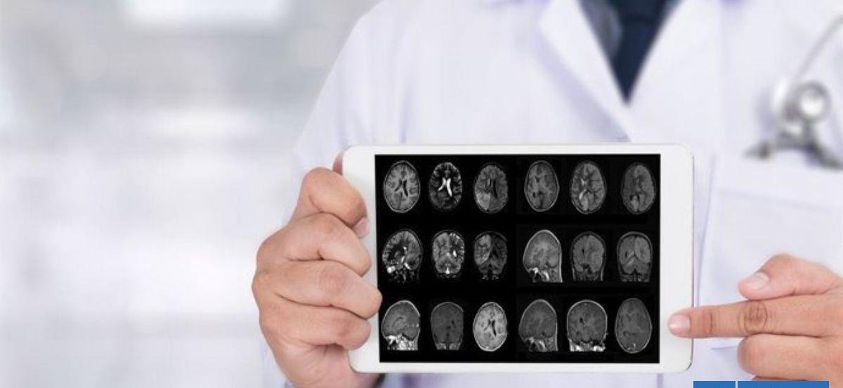 Descubren enfermedades que podrían predecir el Alzheimer hasta 10 años antes de los síntomas