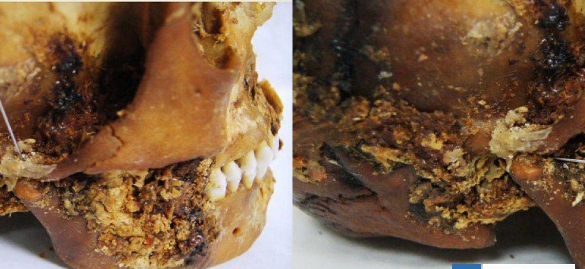 Descubren una cirugía maxilofacial hecha en un cráneo de hace 2.500 años