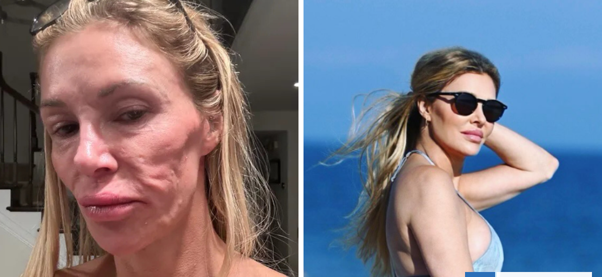 Exmodelo estadounidense dice que tuvo un "parásito" facial causado por falla de sus implantes mamarios