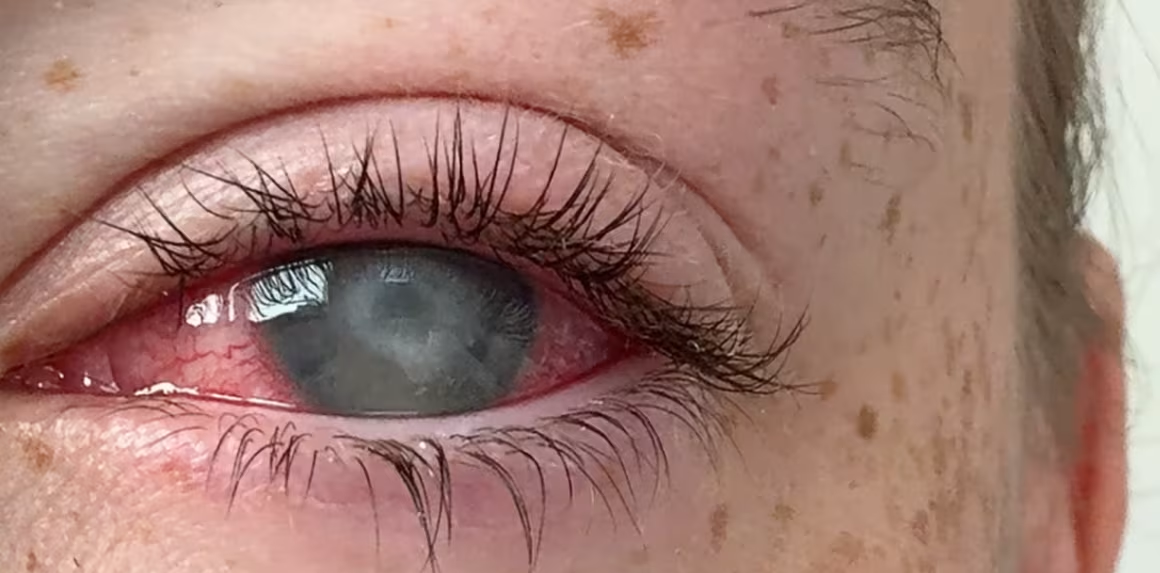 Enfermedad parasitaria ocular que causa ceguera afecta principalmente a quienes usan lentes de contacto. Así puede evitarse